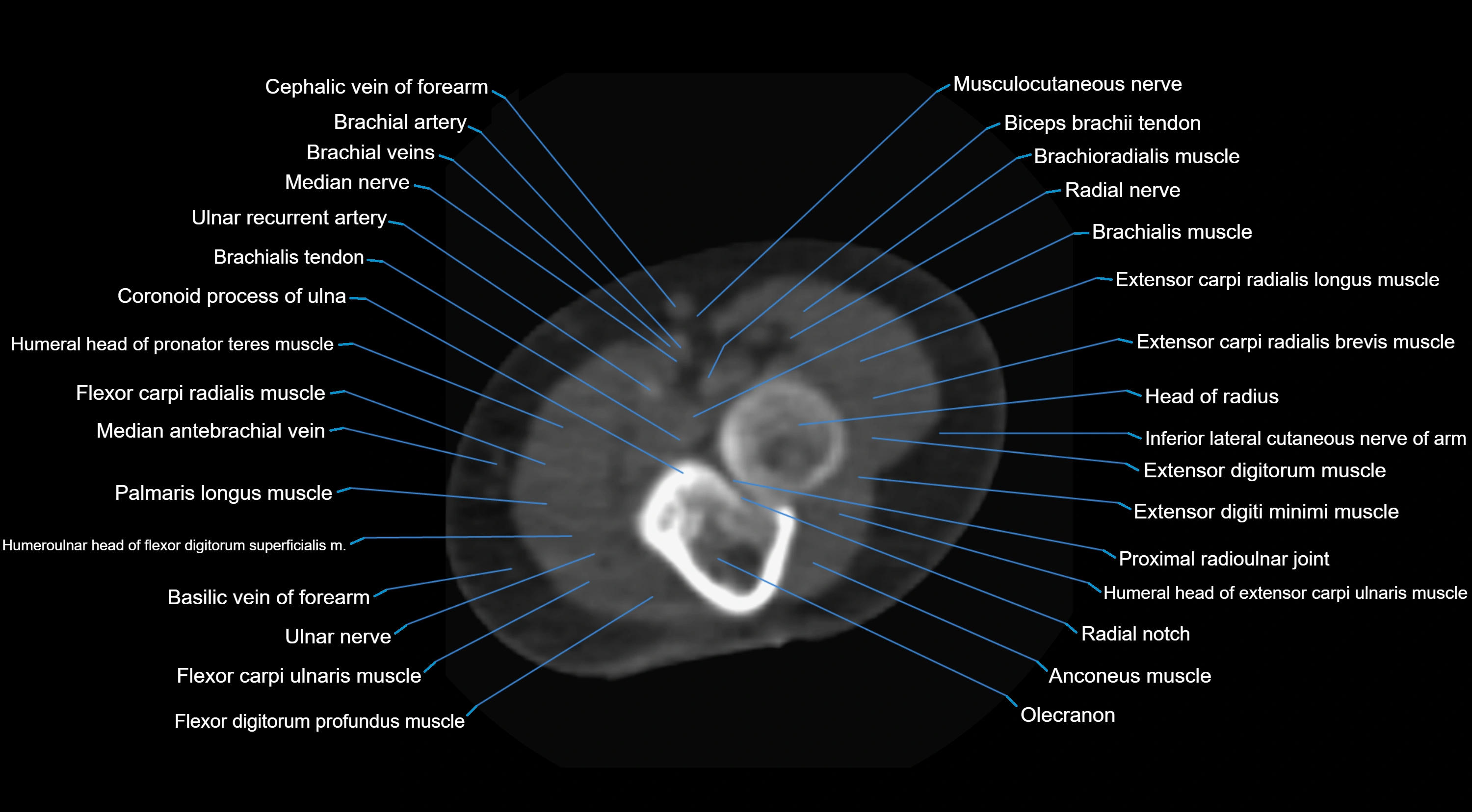 CT elbow axial  cross sectional anatomy labelled  radiology image -00032.webp